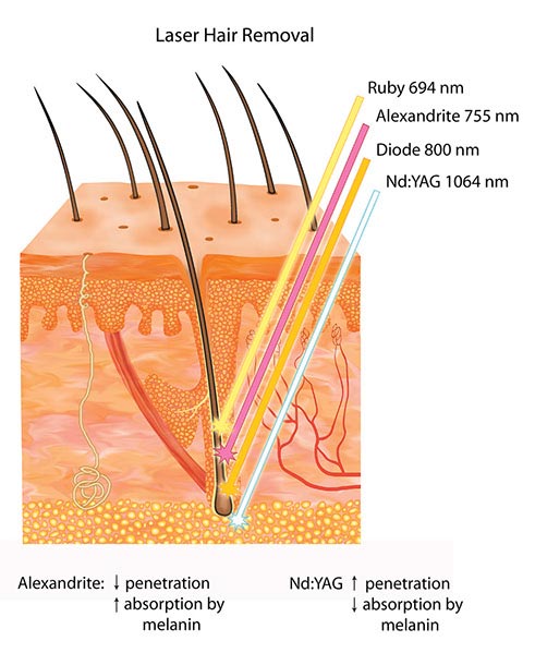 میزان نفوذ لیزر موهای زائد در پوست