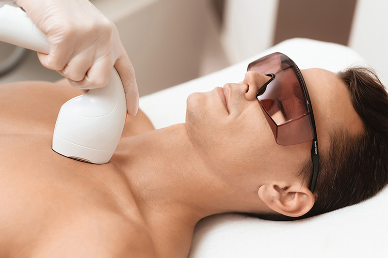 آیا لیزر موهای زائد مردان دائمی است؟