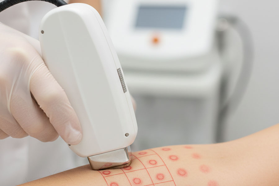 فاصله شات‌ ها در لیزر موهای زائد و تاثیر آن بر نتیجه