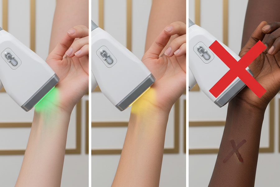 بازدهی لیزر IPL: IPL برای چه پوستی مناسب است؟